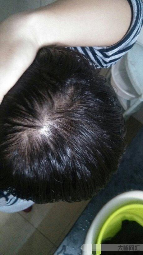 头发稀疏怎么恢复