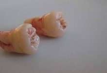智齿一定要拔掉吗-智齿一定要拔掉吗?-大智网汇