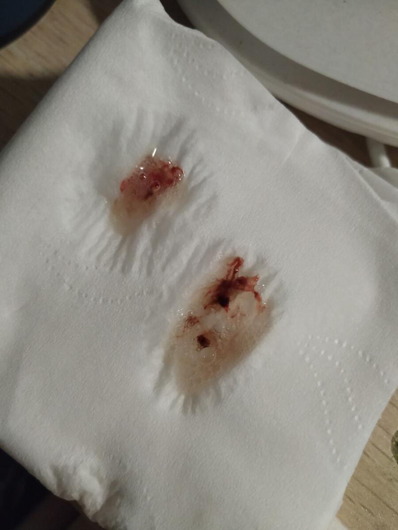 痰里面带血是怎么回事