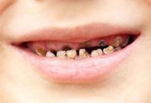 蛀牙如何让它停止腐蚀-蛀牙怎么办?-大智网汇