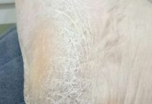 脚后跟干裂起硬皮是什么原因-脚后跟干裂是肝癌吗-大智网汇