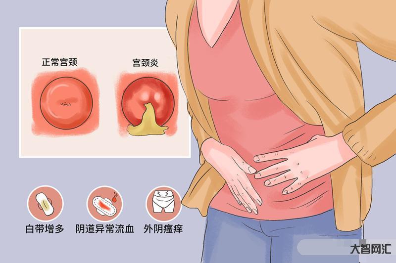 2、宫颈炎的症状是什么?