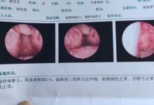 腺样体肥大是什么症状-腺样体肥大是怎么手术的?-大智网汇