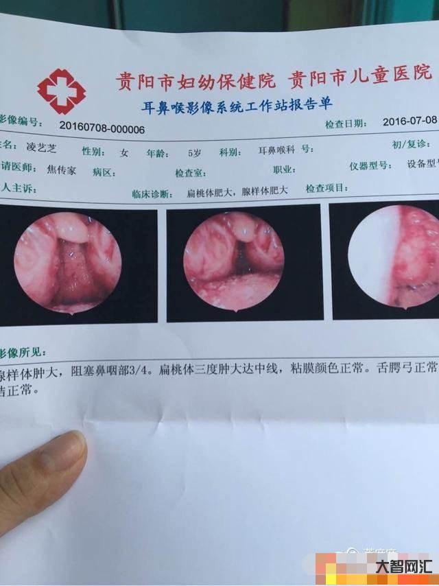2、几岁矫正腺样面容是合适的