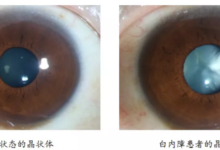 白内障的主要症状是什么-白内障的早期症状-大智网汇