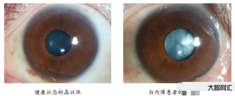1、早期白内障症状