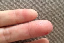 l手上起小水泡很痒怎么回事-手上长的小水泡很痒,是什么原因导致的?-大智网汇