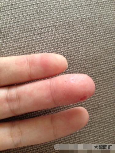 1、手上的小水泡很痒。原因是什么?