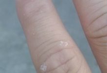 手脱皮是什么原因导致的-手指脱皮这是怎么引起的?-大智网汇