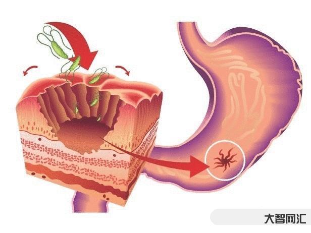 1、胃溃疡的早期症状是什么?胃溃疡的症状是什么?