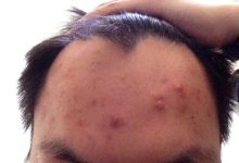 额头长痘痘是什么原因怎么调理-额头长痘痘怎么办到底是什么原因-大智网汇