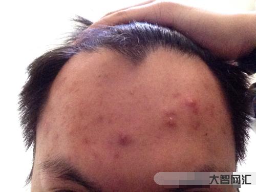 2、额头上长痘痘的原因是什么?