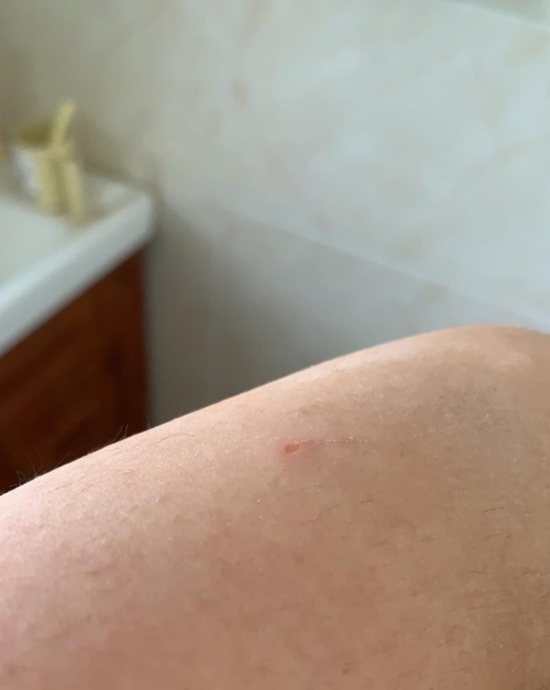 4、被猫抓了一定要打针吗?