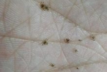 阴虱是什么原因得的-阴虱怎么回事?-大智网汇