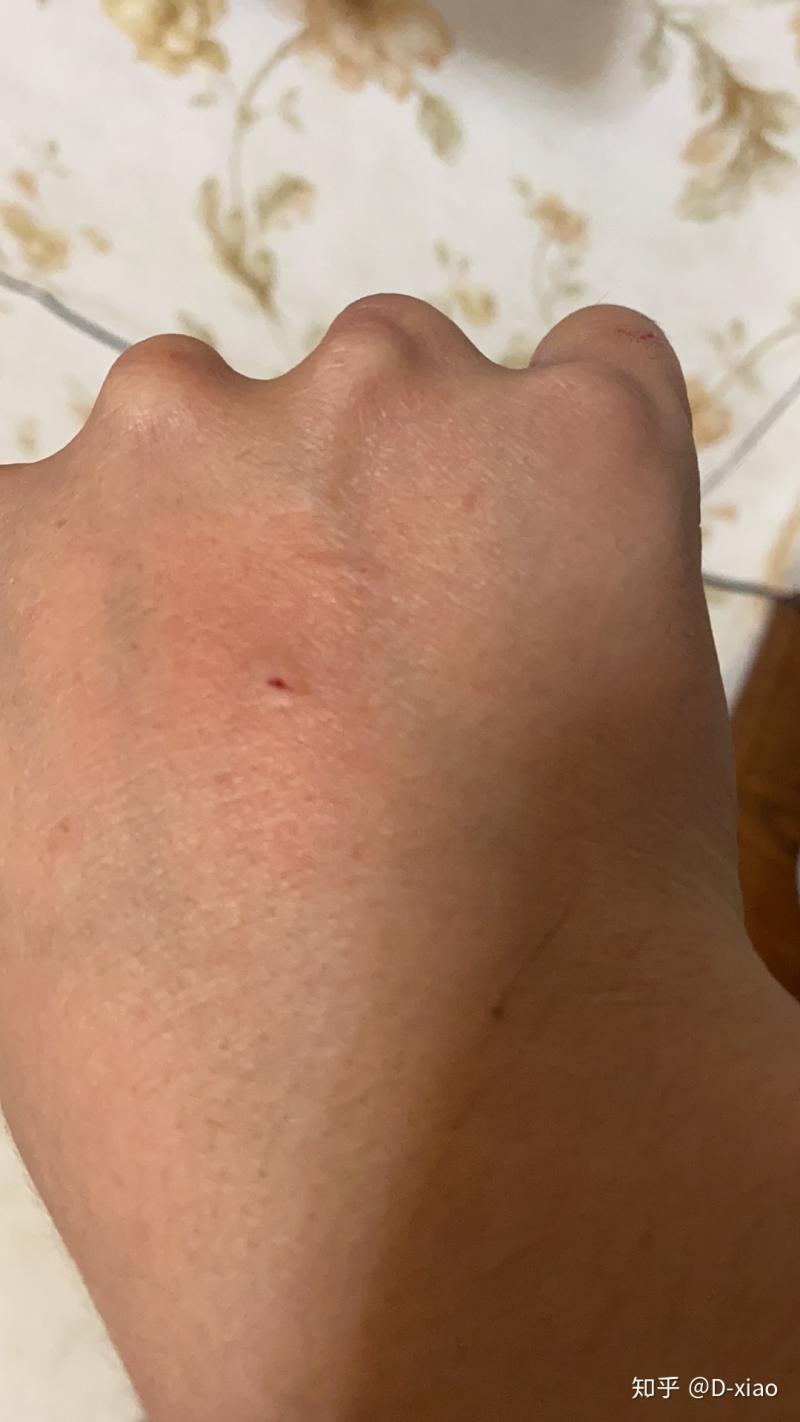 2、被猫抓到轻微破皮要打针吗?