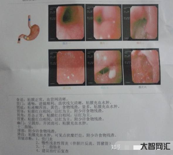 胃炎的症状有哪些-有这5种情况,要做胃镜检查,但注意这2点-大智网汇