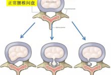 腰椎间盘突出的症状是什么-腰椎间盘突出的症状有哪些-大智网汇