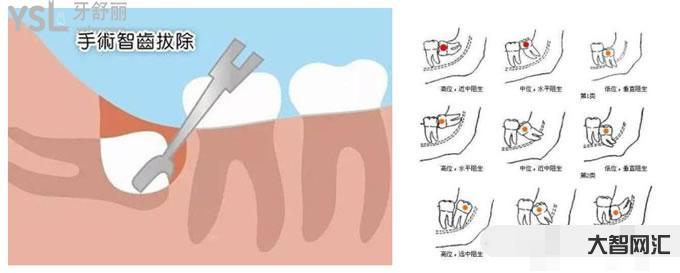 智齿有必要拔吗-立事牙出现问题,必须要拔掉吗?-大智网汇
