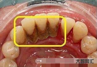 1、如何在家有效去除牙结石?