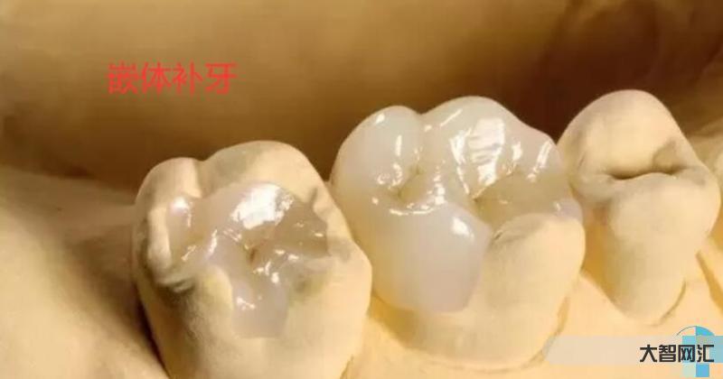 牙冠少一半怎么补最好呢-补牙，如何既省钱又省心?看这里