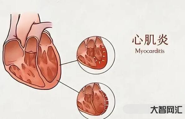 心肌炎有什么症状？引起心肌炎的原因有哪些？怎么治疗