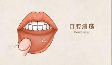 口腔溃疡原因？治疗口腔溃疡最快最有效的方法