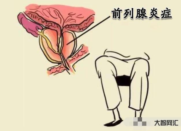 前列腺炎有什么症状和危害性?如何治疗-大智网汇
