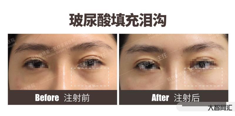 玻尿酸为什么不会溶解-真相来了|玻尿酸真如“他们”说的那般安全吗?