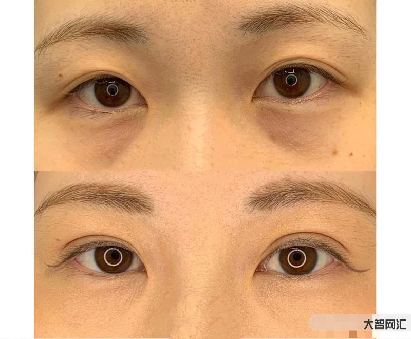 去除眼袋的方法-消除眼袋的方法有哪些呢?-大智网汇
