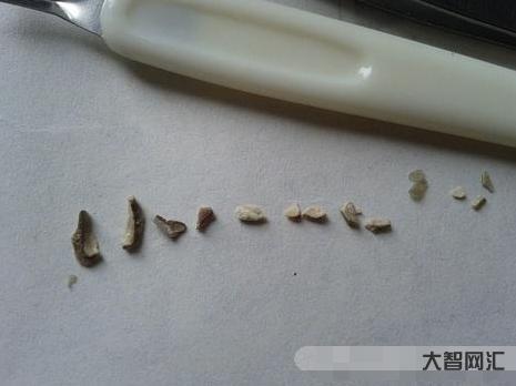 牙结石什么成分组成最多-“牙结石”可以用手抠掉吗?教你一招,牙缝里的脏-大智网汇
