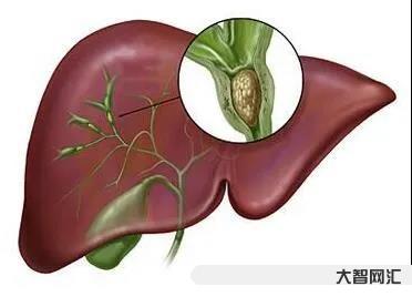 2、肝内胆管结石或钙化灶是什么意思?