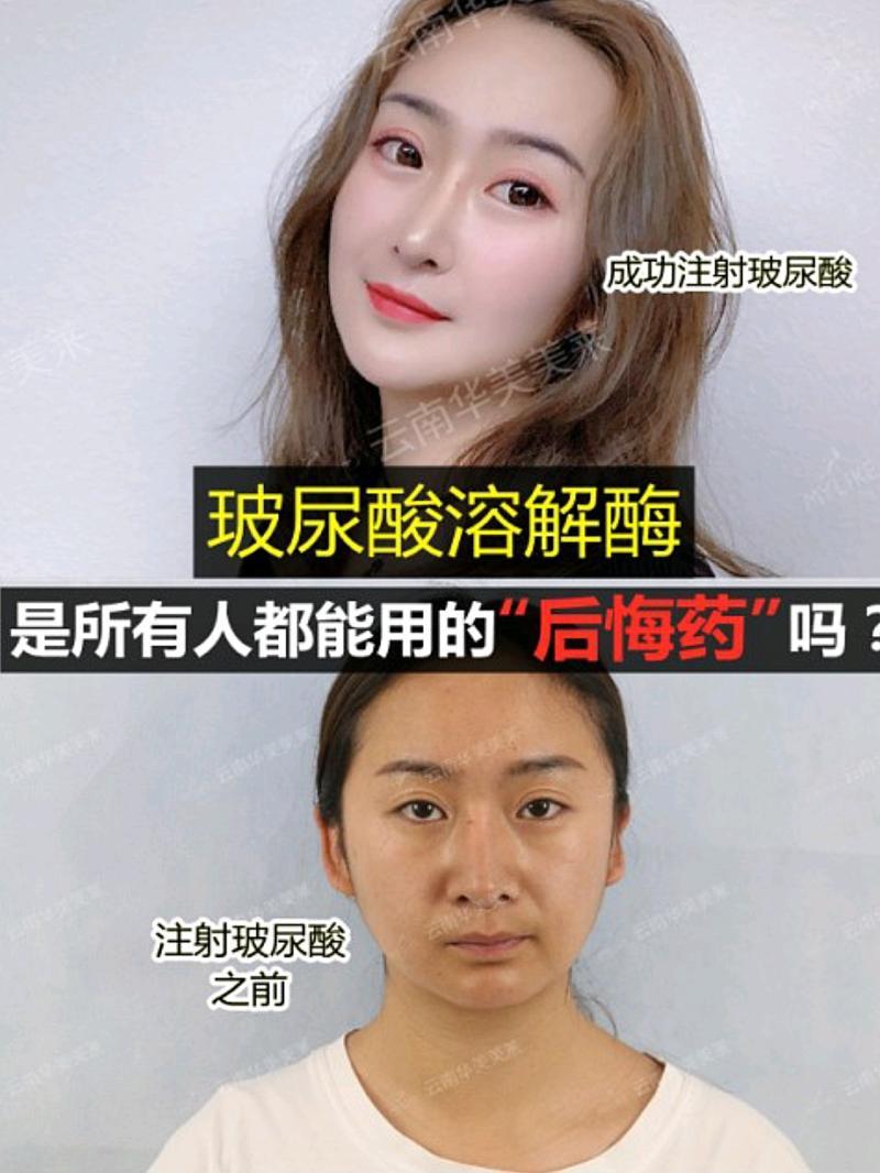 玻尿酸为什么不会溶解-真相来了|玻尿酸真如“他们”说的那般安全吗?