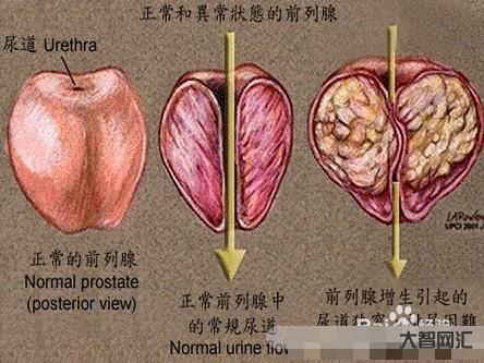 38岁前列腺有增生怎么办-中老年人得了前列腺增生怎么办?不用慌,3大治 38岁前列腺有增生怎么办-中老年人得了前列腺增生怎么办?不用慌,3大治