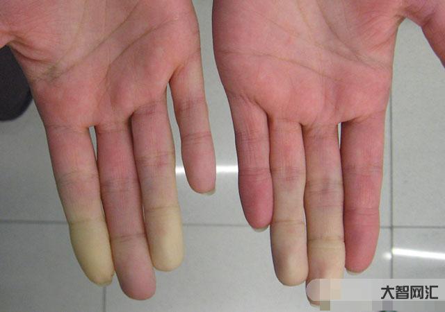 1、红疮狼斑的症状是什么?