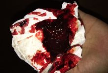 痔疮大便出血怎么办-痔疮拉大便出血怎么办-大智网汇