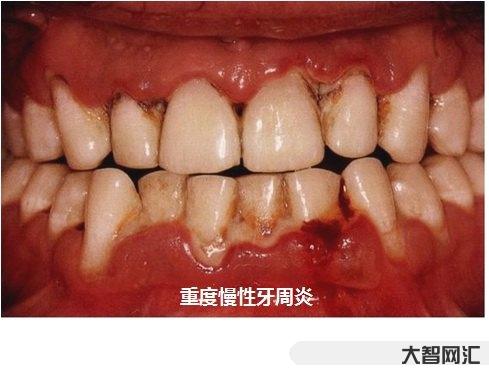 牙齿间歇性串着疼痛-莫名其妙的牙痛是病吗?-大智网汇