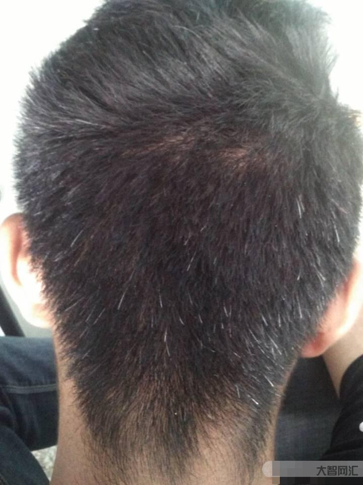 年轻人白发是血热吗-长白头发是缺什么维生素导致的?医学专家详细分析,让-大智网汇