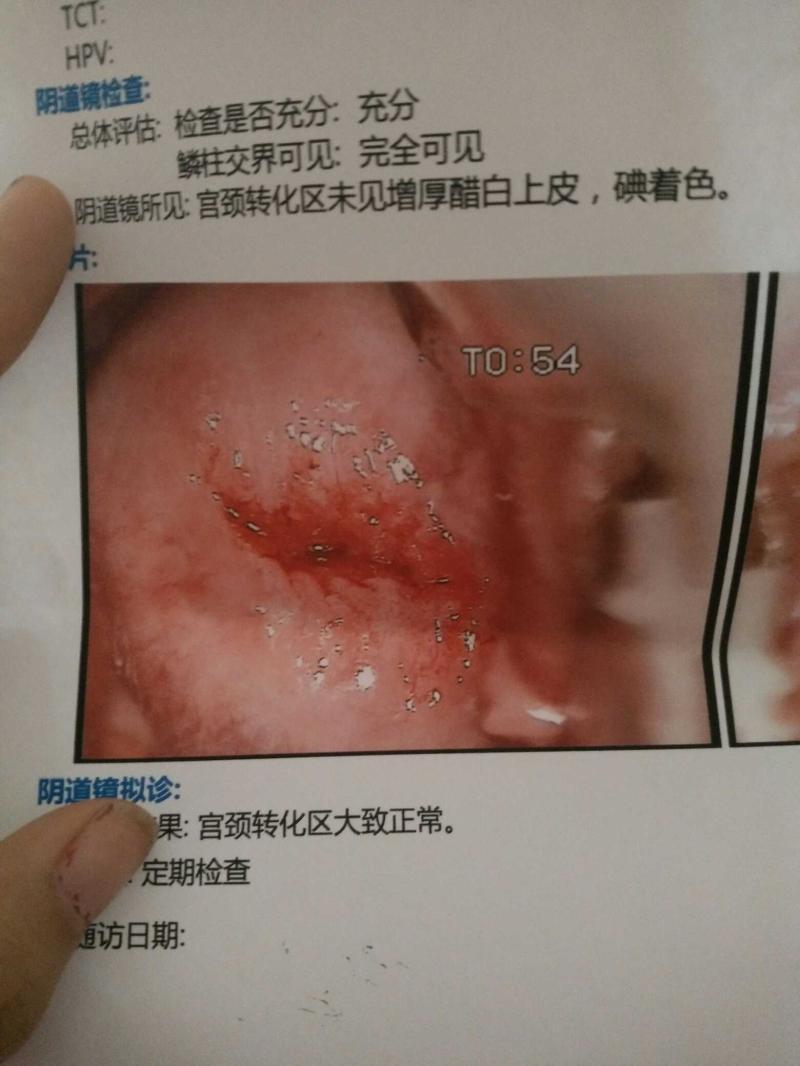宫颈糜烂有什么症状-宫颈糜烂会导致宫颈出血?它还不需要治疗? 宫颈糜烂有什么症状-宫颈糜烂会导致宫颈出血?它还不需要治疗?