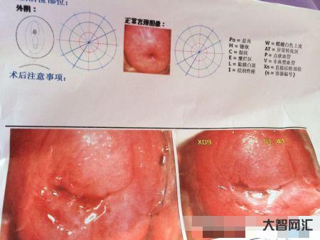 宫颈糜烂有什么症状-宫颈糜烂会导致宫颈出血?它还不需要治疗? 宫颈糜烂有什么症状-宫颈糜烂会导致宫颈出血?它还不需要治疗?