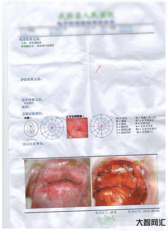 宫颈糜烂有哪些症状-宫颈癌变后,除了小腹疼痛,身体还有2处症状,希望你-大智网汇