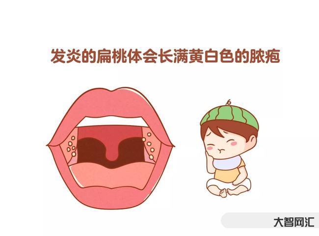 急性化脓性扁桃体炎-扁桃体肿大、表面化脓,一定是扁桃体炎吗? 急性化脓性扁桃体炎-扁桃体肿大、表面化脓,一定是扁桃体炎吗?