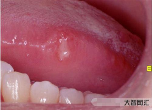 舌头上溃疡怎么治-有一种剧痛叫“口腔溃疡”,补充维C不管用,3种方法更-大智网汇