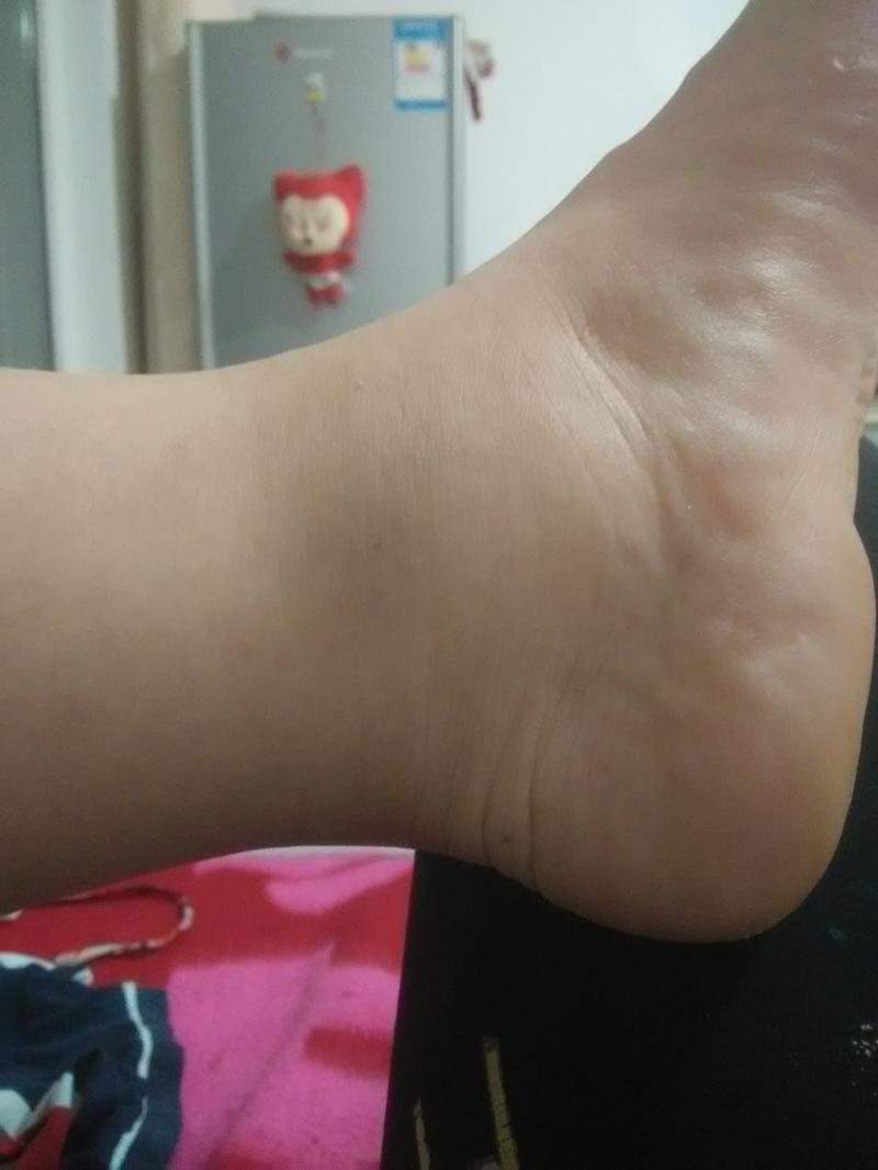 脚踝浮肿是什么原因引起的-孕期脚肿如“面包”,只是因为喝水喝多了?和很-大智网汇