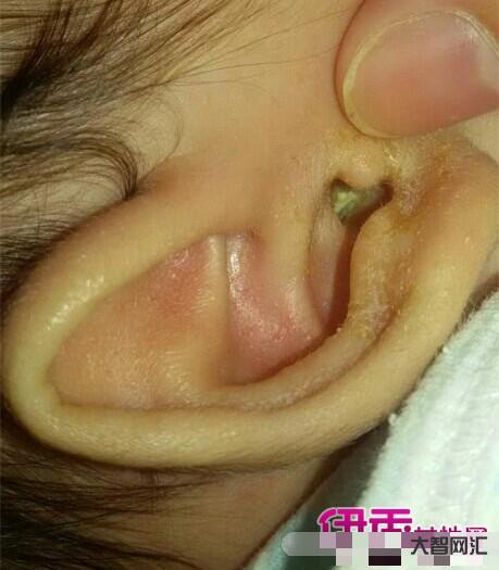 中耳炎症状有哪些表现-中耳炎发病要注意什么?除了积极治疗,还要注意3件-大智网汇