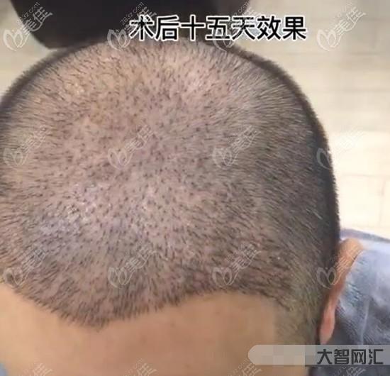 植发5000个毛囊多少钱-人均2.8万!看到植发价格单,头更“凉”了-大智网汇