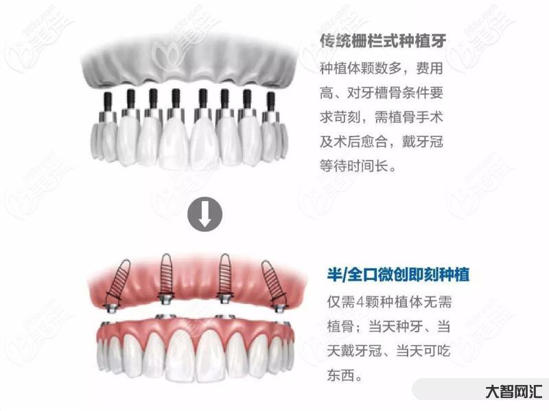 种牙多少钱一颗啊-集采落地后种牙怎么选?种一颗牙便宜多少钱?-大智网汇