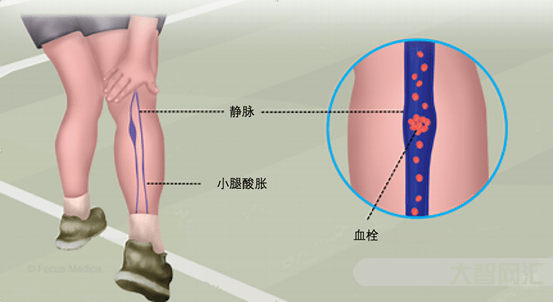 小腿酸胀痛什么原因引起的-啥是膝关节退行性疾病,小腿酸胀和它有关系吗?-大智网汇