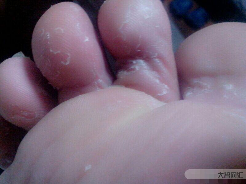 脚气烂脚趾缝痒溃烂怎么治-用于治疗脚气的11种外用药-大智网汇