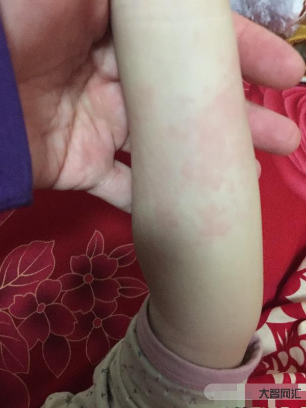 身上起红色疙瘩很痒怎么回事-皮肤风团 荨麻疹你晓得咋回事吗?-大智网汇