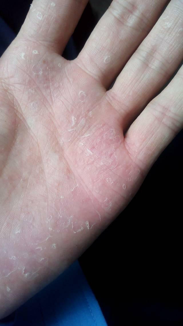 手脱皮是什么原因导致的-手脱皮是怎么回事?通常是缺乏这种维生素,补一补-大智网汇